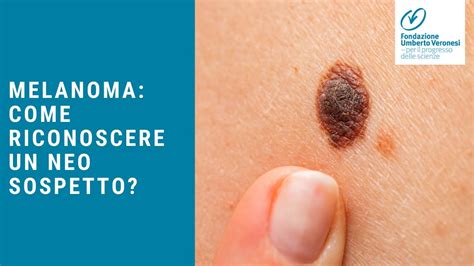 come si riconosce un melanoma
